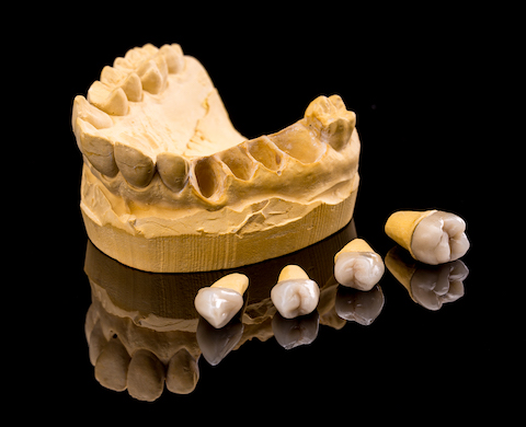 Ceramic dental implants and gypsum layout